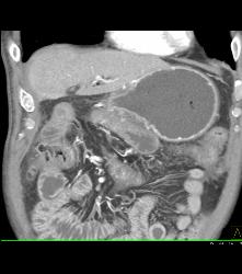 Antral Carcinoma - CTisus CT Scan