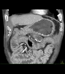 Antral Carcinoma - CTisus CT Scan