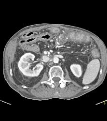 Antral Carcinoma - CTisus CT Scan