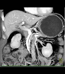 Antral Carcinoma - CTisus CT Scan