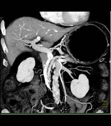 Antral Carcinoma - CTisus CT Scan