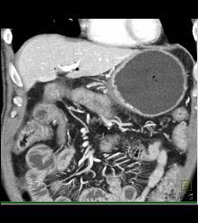 Antral Carcinoma - CTisus CT Scan