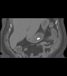 Antral Carcinoma - CTisus CT Scan