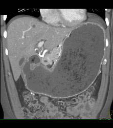 Gastric Outlet Onstruction to Tumor - CTisus CT Scan