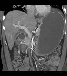 Antral Carcinoma- See Sequence - CTisus CT Scan