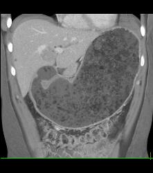 Antral Carcinoma- See Sequence - CTisus CT Scan