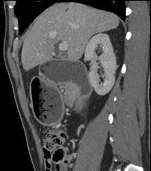 Antral Carcinoma- See Sequence - CTisus CT Scan