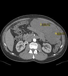 GIST Tumor - CTisus CT Scan