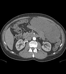 GIST Tumor - CTisus CT Scan