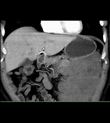 GIST Tumor - CTisus CT Scan