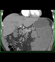 GIST Tumor - CTisus CT Scan