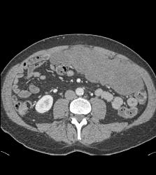 GIST Tumor - CTisus CT Scan