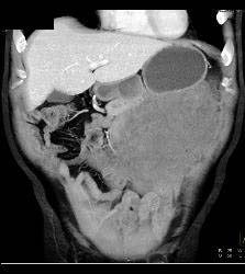 GIST Tumor - CTisus CT Scan