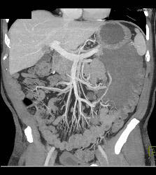 GIST Tumor - CTisus CT Scan