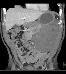 GIST Tumor - CTisus CT Scan