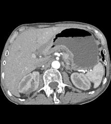 Antral Carcinoma With Celiac Nodes - CTisus CT Scan