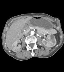 Antral Carcinoma With Celiac Nodes - CTisus CT Scan