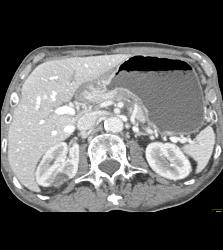 Antral Carcinoma With Celiac Nodes - CTisus CT Scan