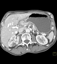 Antral Carcinoma With Celiac Nodes - CTisus CT Scan