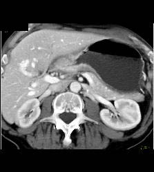 Antral Carcinoma - CTisus CT Scan