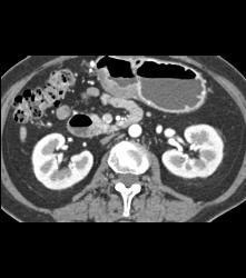 Antral Carcinoma - CTisus CT Scan