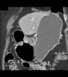 Antral Carcinoma - CTisus CT Scan