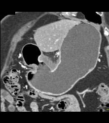 Antral Carcinoma - CTisus CT Scan