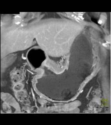 Antral Carcinoma - CTisus CT Scan