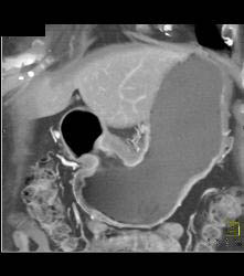 Antral Carcinoma - CTisus CT Scan