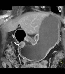 Antral Carcinoma - CTisus CT Scan