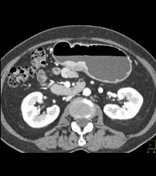 Antral Carcinoma - CTisus CT Scan