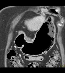 Antral Carcinoma - CTisus CT Scan