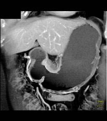 Antral Carcinoma - CTisus CT Scan