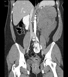 GIST Tumor - CTisus CT Scan