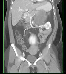 GIST Tumor - CTisus CT Scan