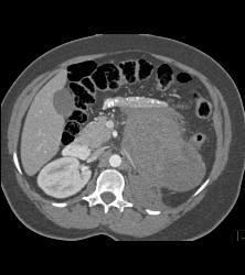 GIST Tumor - CTisus CT Scan