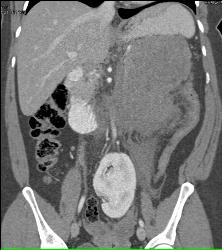 GIST Tumor - CTisus CT Scan