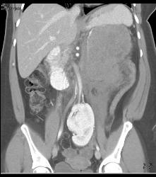 GIST Tumor - CTisus CT Scan