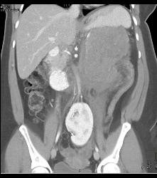 GIST Tumor - CTisus CT Scan