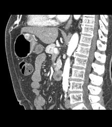 Glomus Tumor - CTisus CT Scan