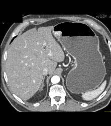 Glomus Tumor - CTisus CT Scan