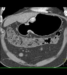 Glomus Tumor - CTisus CT Scan