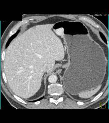 Glomus Tumor - CTisus CT Scan