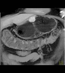 Glomus Tumor - CTisus CT Scan