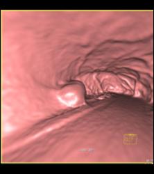 Glomus Tumor - CTisus CT Scan