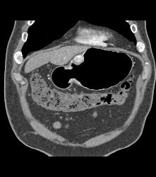 Glomus Tumor - CTisus CT Scan