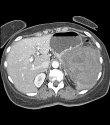 GIST Tumor - CTisus CT Scan