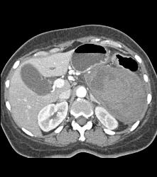 GIST Tumor - CTisus CT Scan