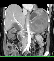 GIST Tumor - CTisus CT Scan