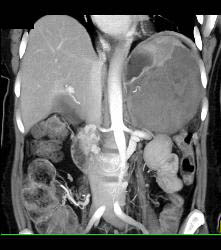 GIST Tumor - CTisus CT Scan